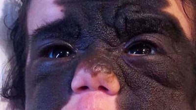 ‘Batman’ birthmark is finally removed from girl following ground-breaking procedure