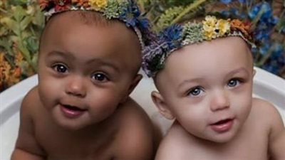 A TALE OF UNIQUENESS: TWINS WITH VARIED SKIN COLORS, TWO DECADES ON