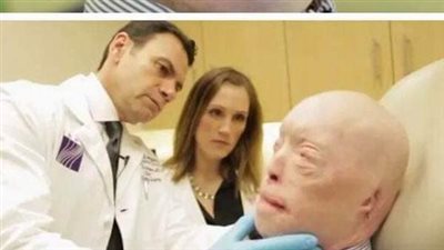 Patrick Hardison Received A New Face After Third-degree Burns, This Is Him Today