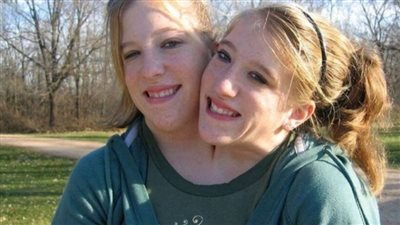 «One husband for two sisters! Siamese twins revealed their wedding pictures!»