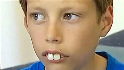 His Classmates Called Him “Rabbit Boy” – But Wait Till You See Him Now