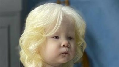 Albino sisters born 12 years apart become modeling sensations