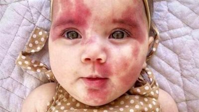 Mom paints face to look like daughter’s heart-shaped port wine birthmark