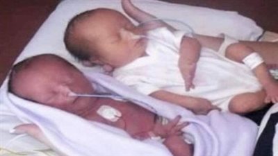 “Overcoming Prejudice”: A Family’s Journey with Down’s Syndrome