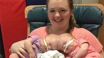 «What’s New With The Siamese Twins Who Split Up in 2017? The Story of Siamese Twins and how they look now!»😯