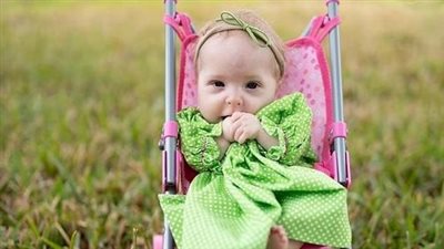 “Tiny Miracle”: this little girl looks like a living doll
