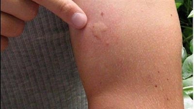 Goodbye mosquitoes!