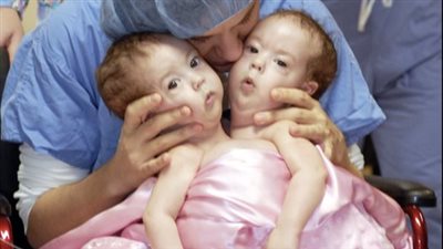 10 years ago these conjoined twins were separated through advanced surgery: Now they are all grown up