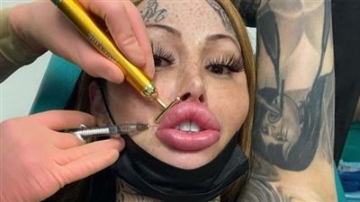 Woman who wants to become a ‘forest elf,’ gets Barbie nose and cat eyes in new extreme procedure