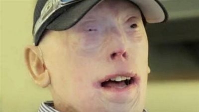 Patrick Hardison Received A New Face After Third-degree Burns, This Is Him Today – Animals