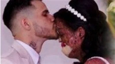 Woman with rare skin condition overcomes negativity and finds true love