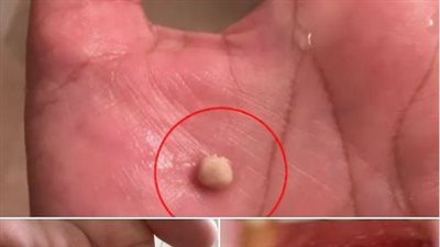 Here’s what you need to know about tonsil stones – the weird pimple-like growths in your throat