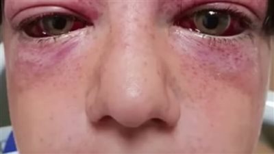 Playground craze leaves 11-year-old boy “looking like an alien” – mom issues warning for parents
