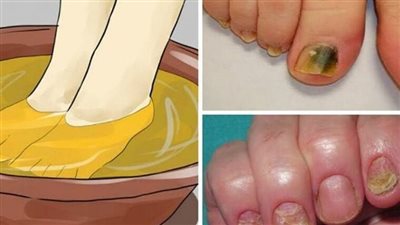 5 natural remedies to treat nail fungus