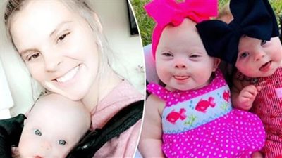 Celebrating the Beauty of Rare Twins with Down Syndrome